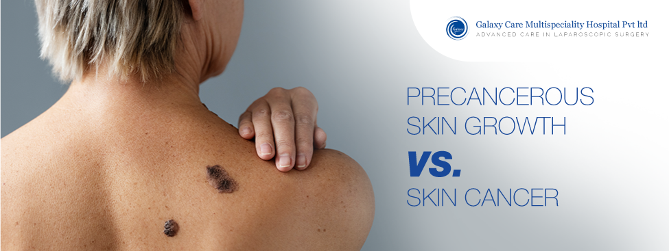 Decoding the Difference: Precancerous Skin Growths vs. Skin Cancer