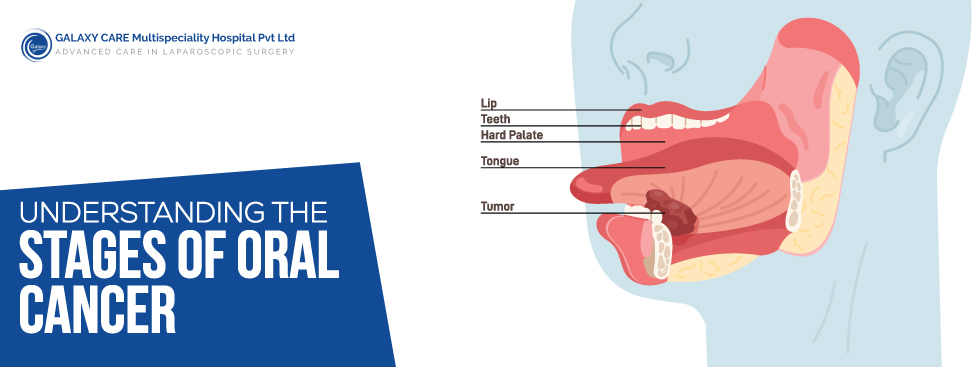 Understanding the Stages of Oral Cancer A Guide for Patients